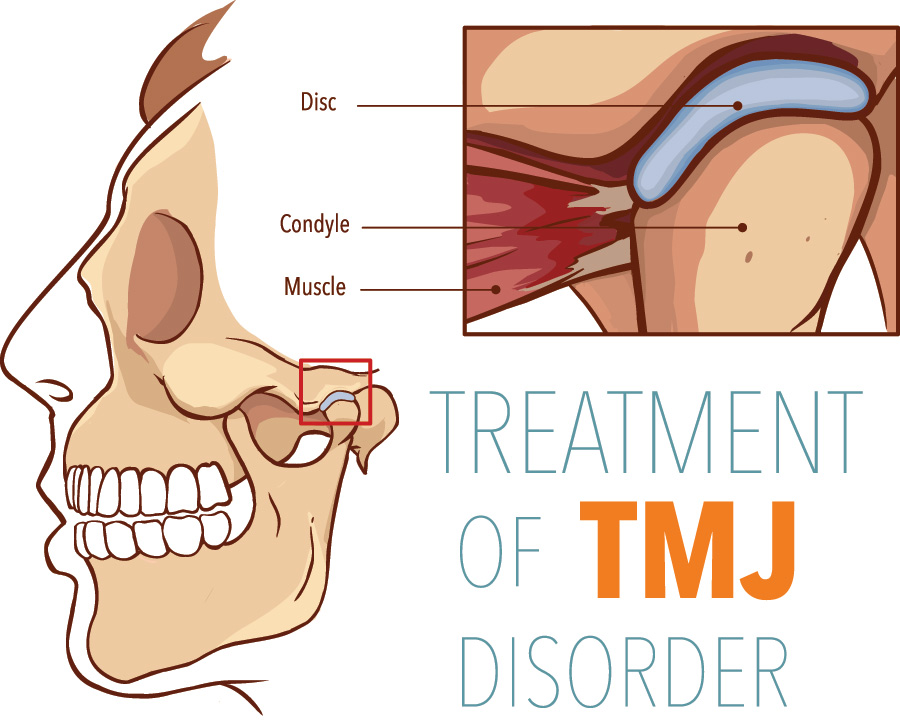 temporomandibular-disorder